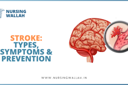 Brain Stroke: Types, Causes, Symptoms, Prevention and Treatment